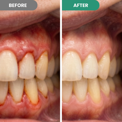 Teeth Repair Pen.